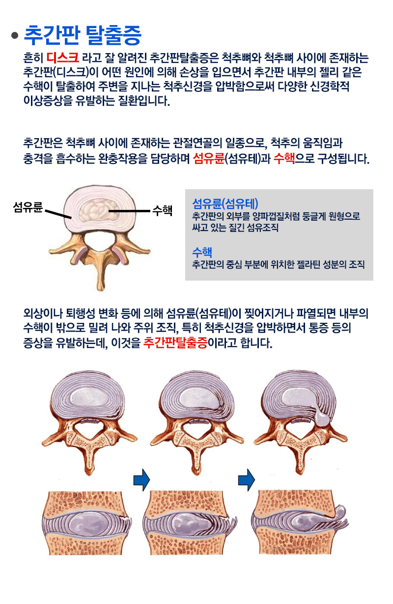 허리 추간판탈출증은 허리디스크 | 새나래병원